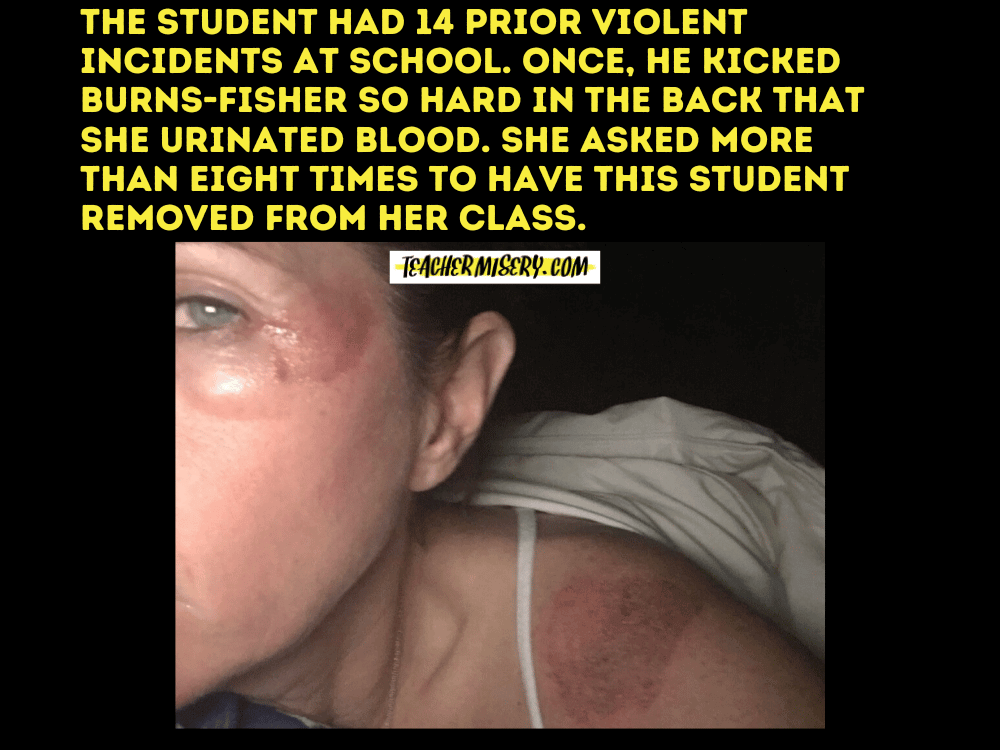 Woman with eye and shoulder bruises.