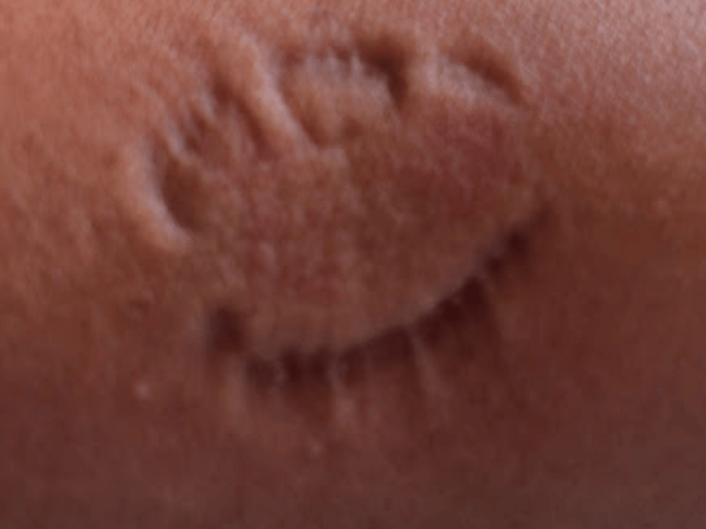 Close up of human bite mark on skin.