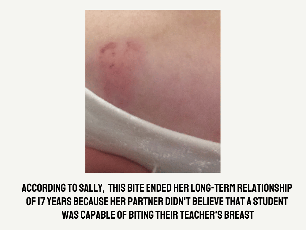 Human bite mark on skin with caption - According to Sally, this bite ended her long-term relationship of 17 years because her partner didn't believe a student was capable of biting their teacher's breast.