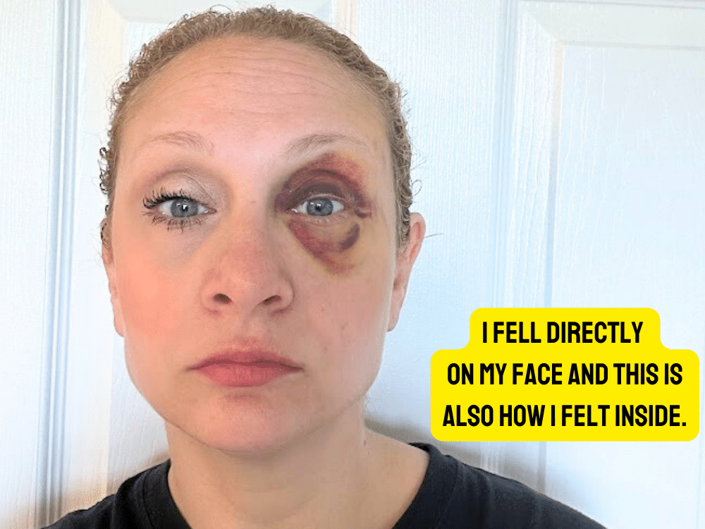 The author - Jane Morris - takes a selfie with a black eye after quitting her teaching job and falling on her face.